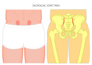sacroiliac joint pain